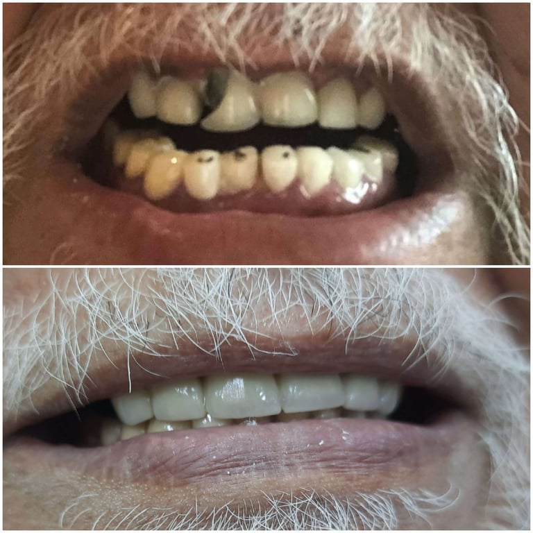 Before and After Full Mouth Rehabilitation