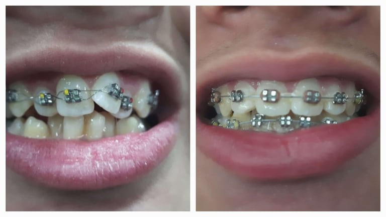 Before and after Braces