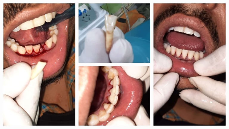 Reimplantation of Tooth - Before & After