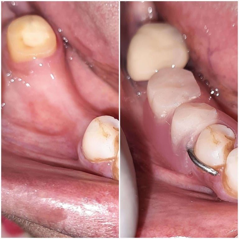 RPD Removable Partial Denture Before and After
