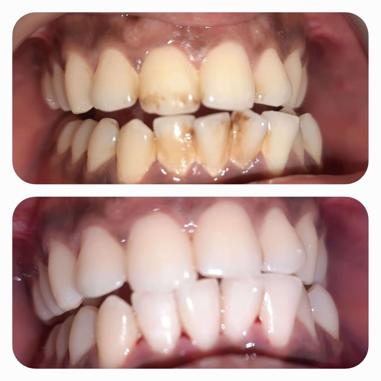 Before & After Pic of Teeth Cleaning Service in Greater Noida at Peoples Dental Clinic