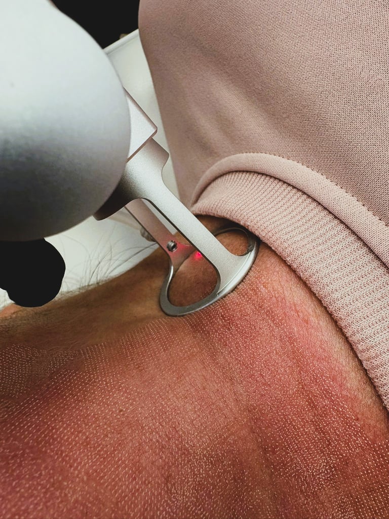 Fractional CO2 Laser Treatment on Neck