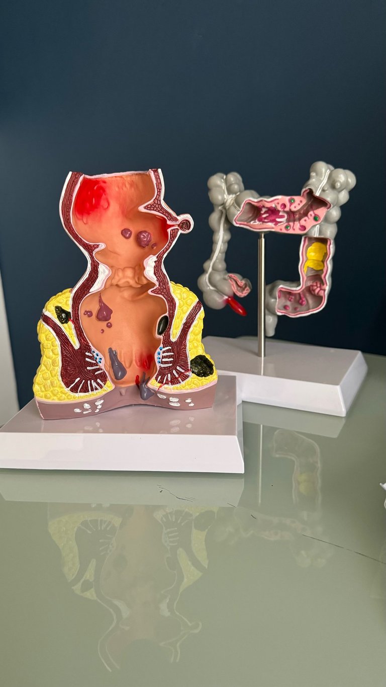 Anatomical models of the rectum and colon showing internal and external hemorrhoids and bowel conditions.