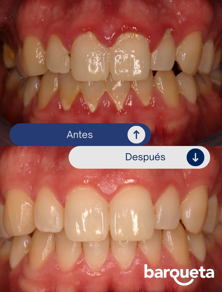 resultado tras tratamiento de periodoncia en sevilla