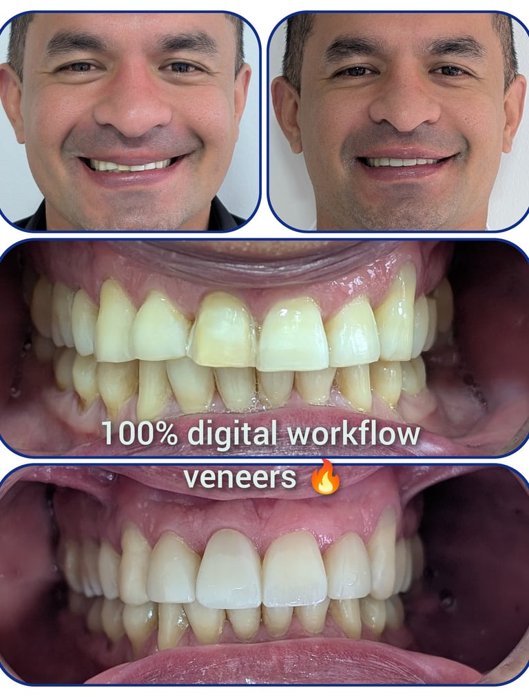 natural dental veneers