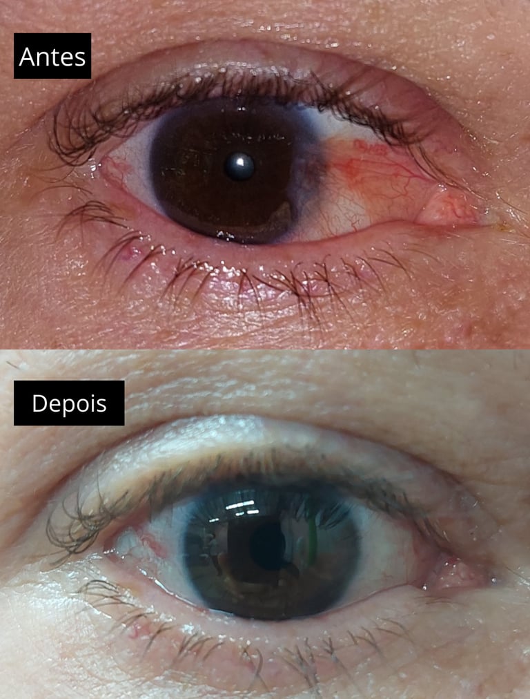 foto mostrando o antes e depois de uma cirurgia de pterigio