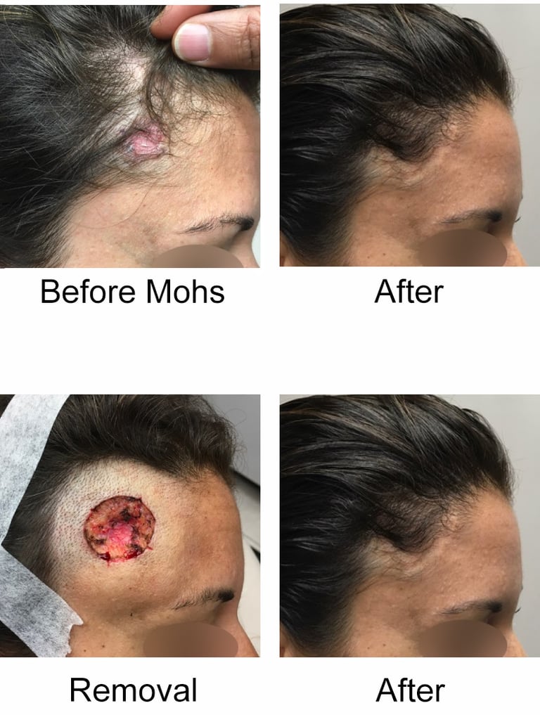Mohs Surgery Before and After