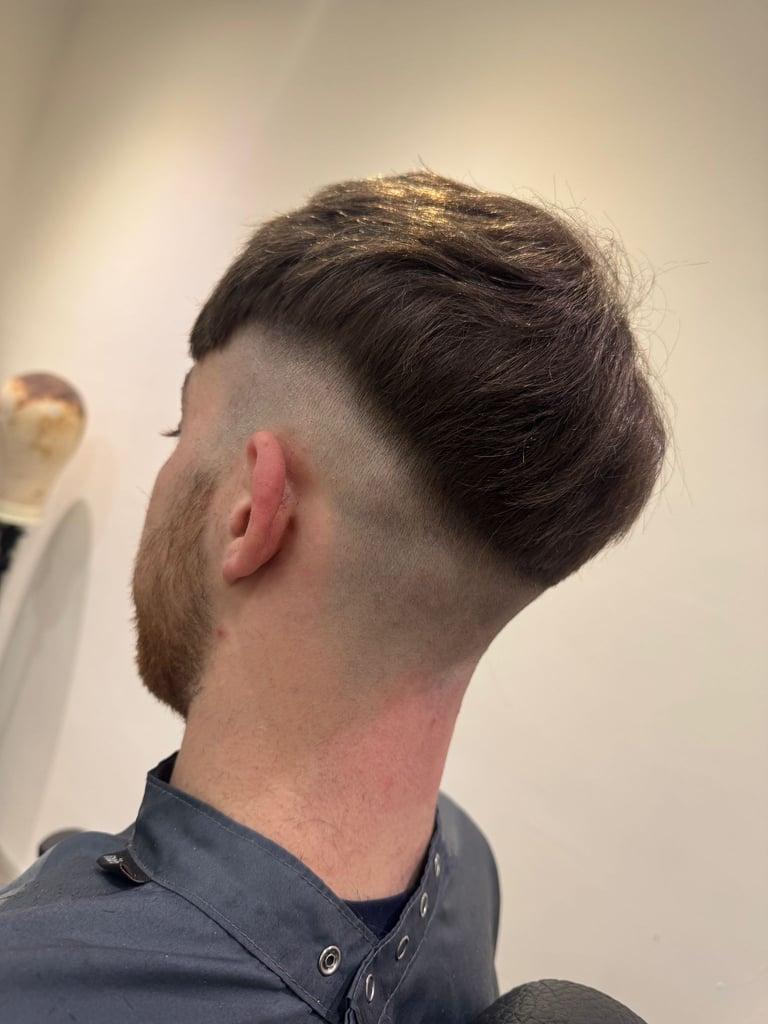 After instant hair Transplant system in Hull by HairLabUK