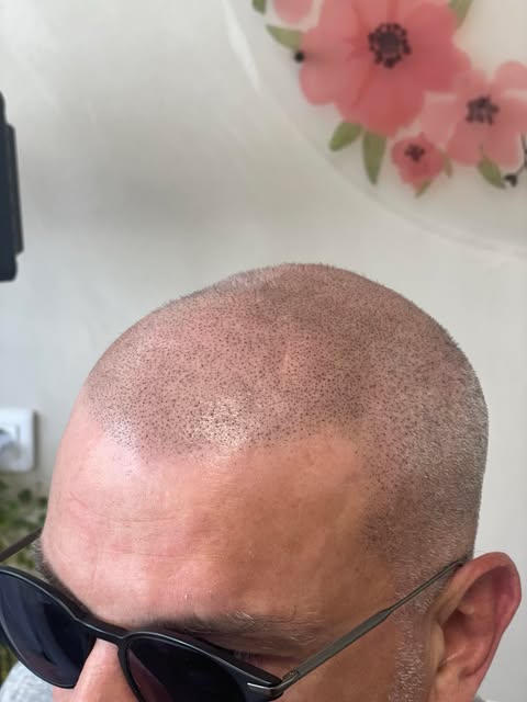 homme tatouage cheveux micropigmentation capillaire chauve 