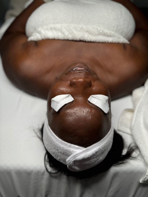 Chemical Peels to brighten and control hyperpigmentation.