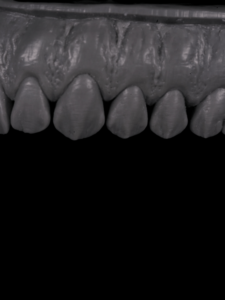 A 3D grayscale scan of a dental arch showing upper teeth and gum texture for orthodontic planning.