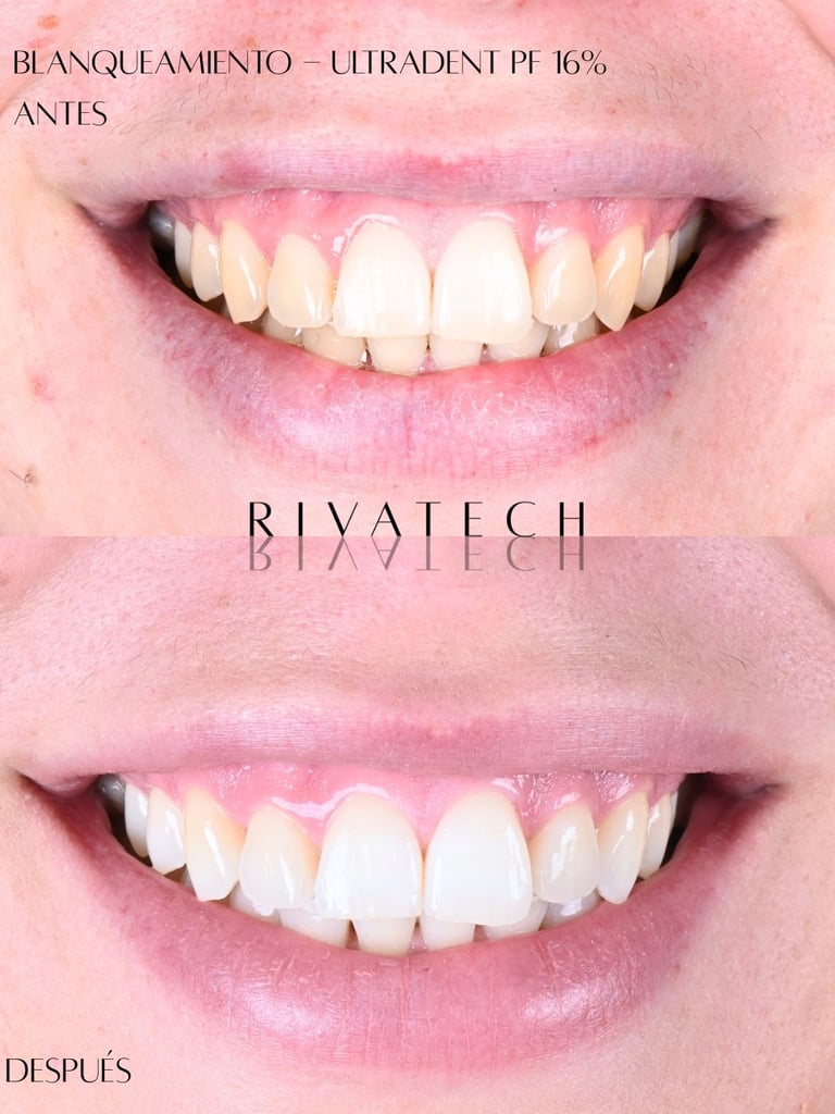 Before and after comparison of professional teeth whitening using Ultradent PF 16% gel.