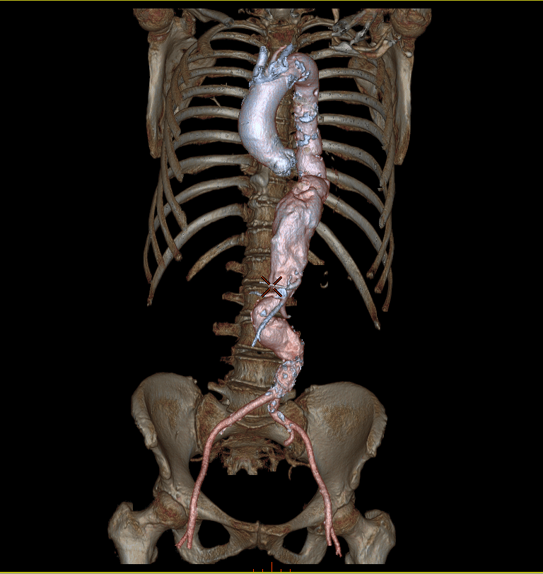 Anévrisme de l'aorte thoracique