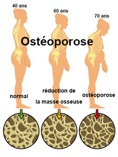 osteoporose musculation
