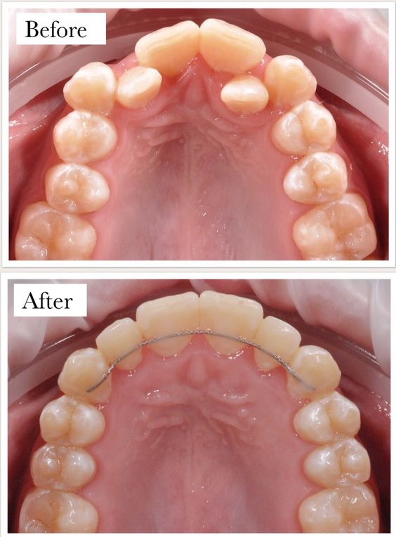 Ortho treatment/Braces for front teeth in  in white castle dental clinic katraj pune