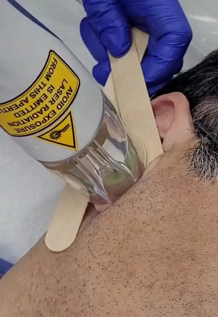 Ear hair removal laser at Ariana Esthetic Edmonton