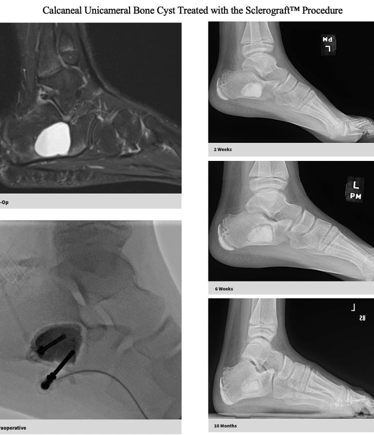MRI-unicameral-bone-cyst-calcaneus-sclerograft.jpg