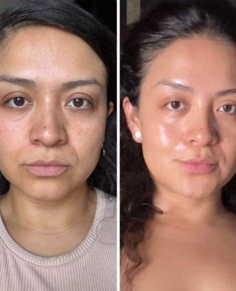 Awoman with a before and after photo after using a Riman skin care product