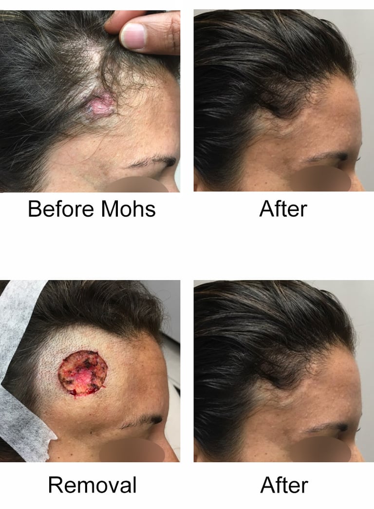 Before and after images showing Mohs surgery removal of skin cancer with successful healing