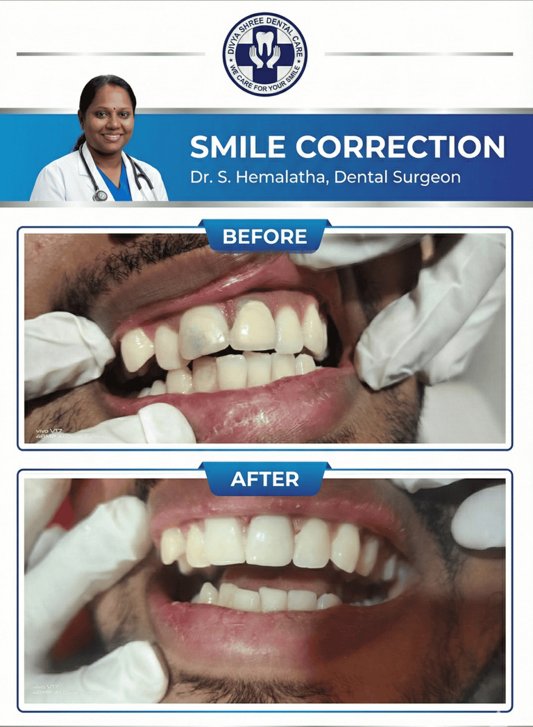 Smile Correction before and after results at Divya Shree Dental Care in HSR Layout