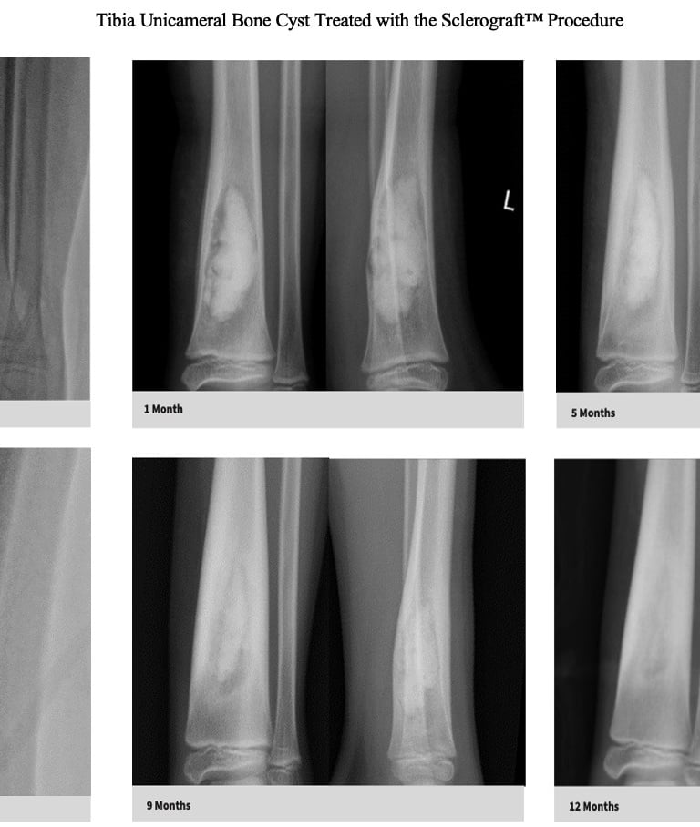 MRI-unicameral-bone-cyst-fibula-sclerograft.jpg