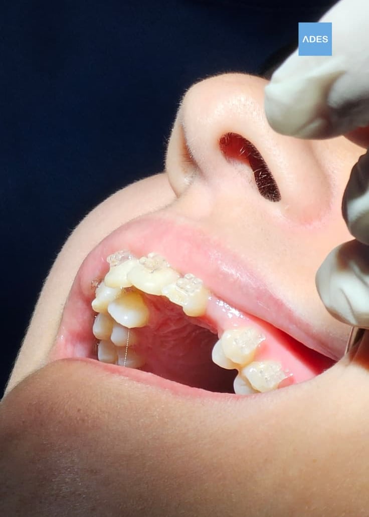 brackets infantil