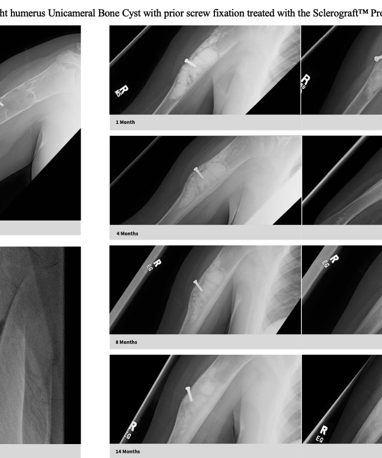 xray-unicameral-bone-cyst-humerus-prior-surgery-sclerograft.jpg