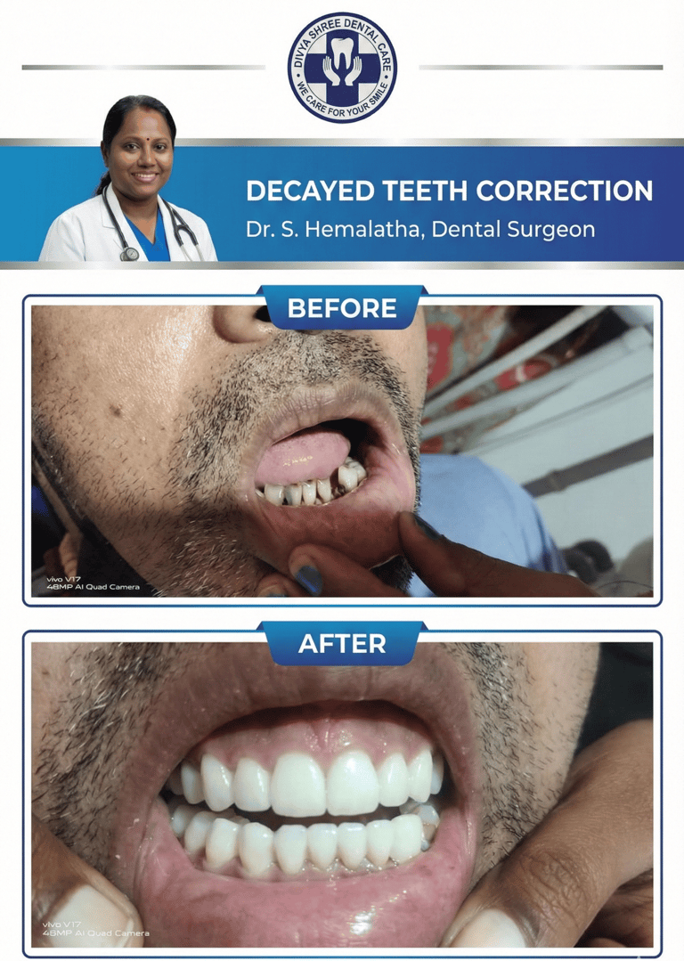 Decayed Teeth correction at Divya Shree Dental Clinic in HSR Layout, Bengaluru