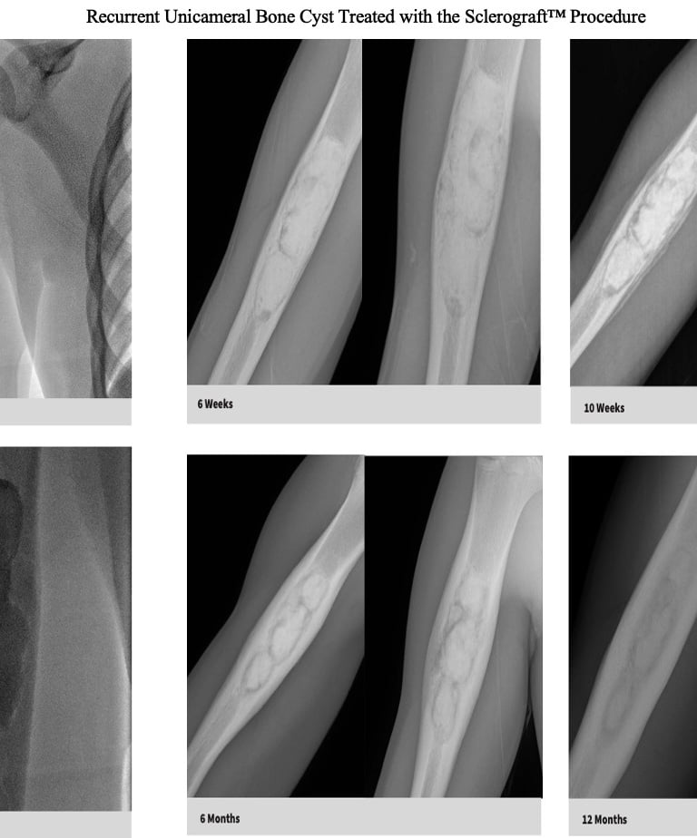 xray-unicameral-bone-cyst-humerus-recurrence-sclerograft.jpg