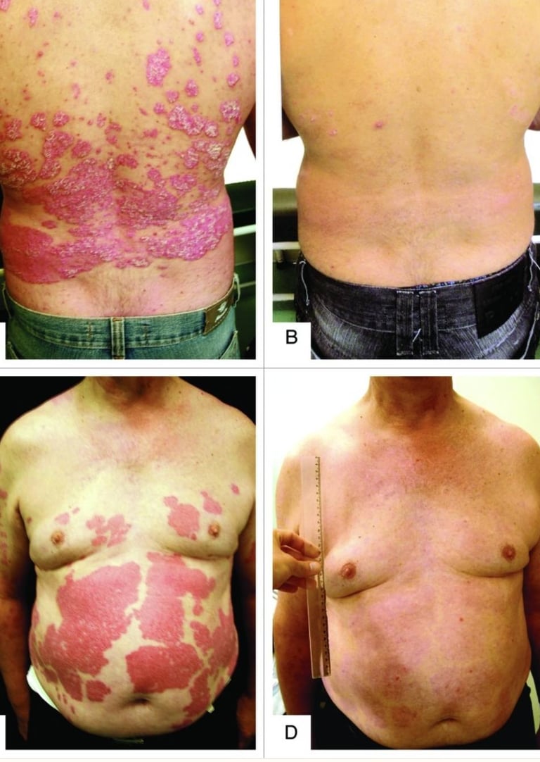 tratamiento para psoriasis