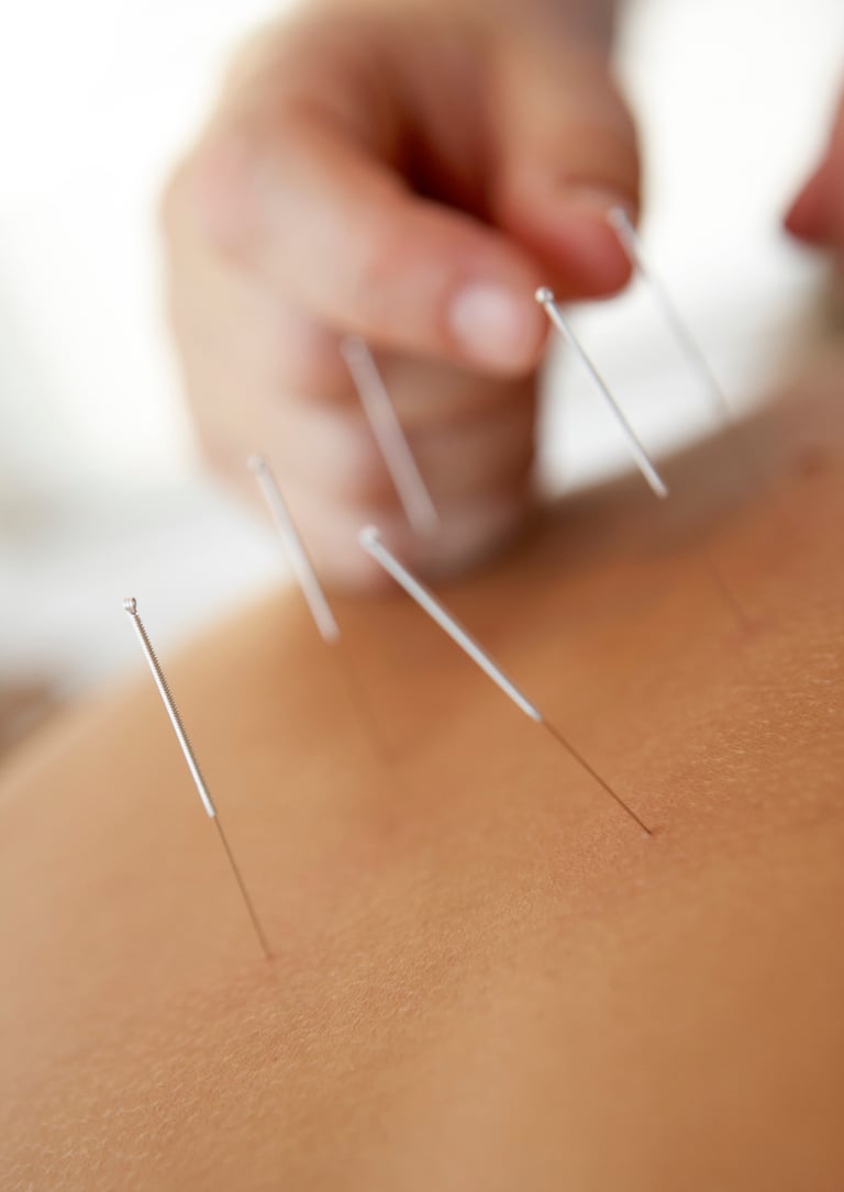 Une personne se fait poser des aiguilles d'acupuncture lors d'une séance de médecine chinoise