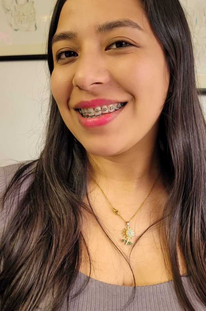 Sonrisa perfecta después de ortodoncia en DUPRINS Lima - Brackets y alineadores dentales