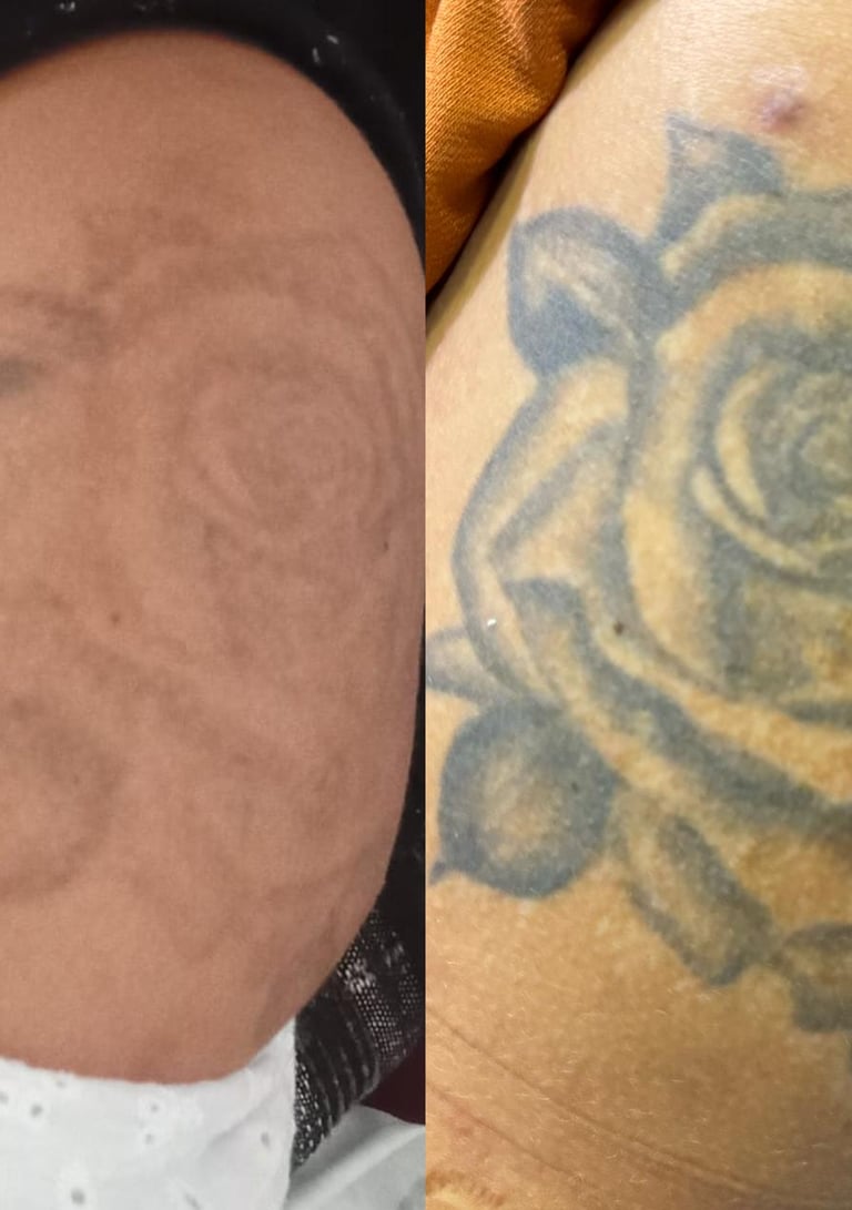 resultado de tratamento de laser para remoção de pigmentos