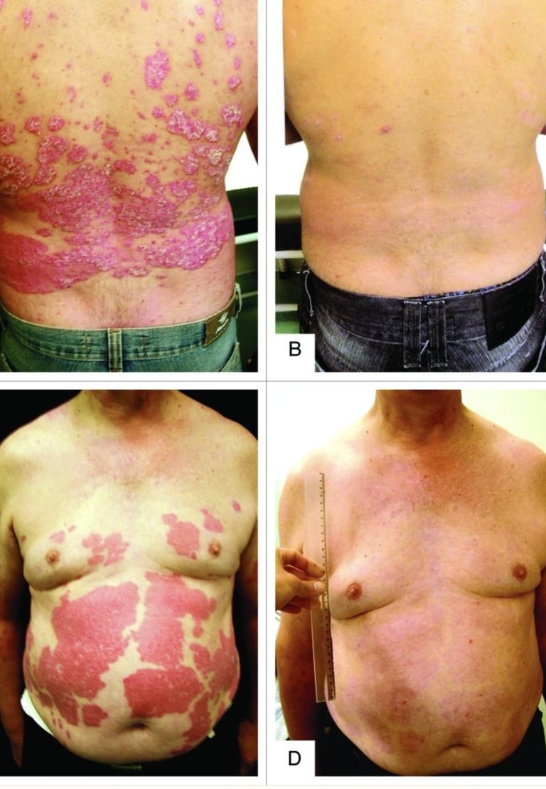 Imágenes de antes y después del Protocolo Coimbra como tratamiento para psoriasis.