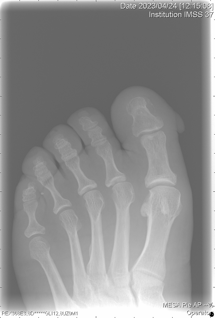 radiografía de fibroqueratoma digital