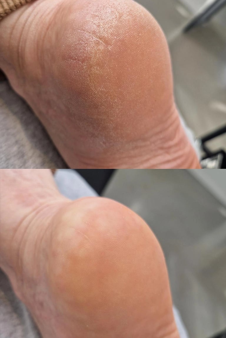 Soin des pieds callosités avant/après