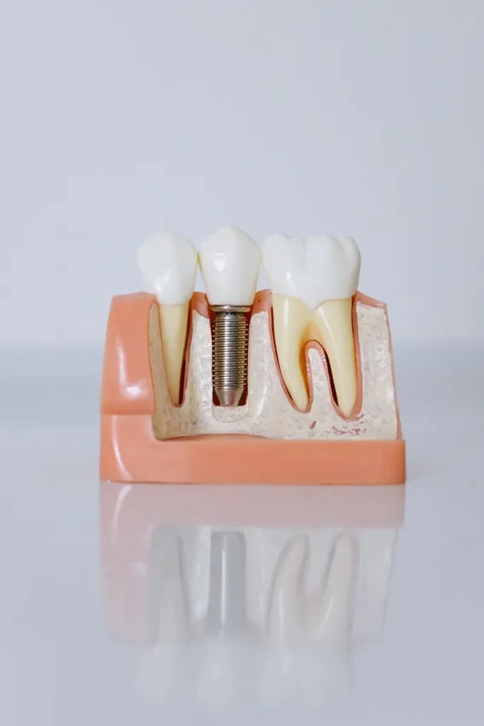 Implantes dentales en Sevilla