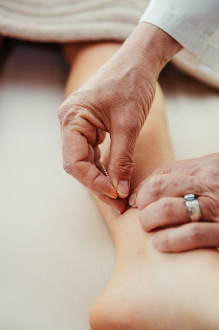 Acupuncture