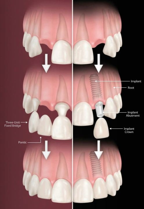 diagram of bridge versus implant therapy