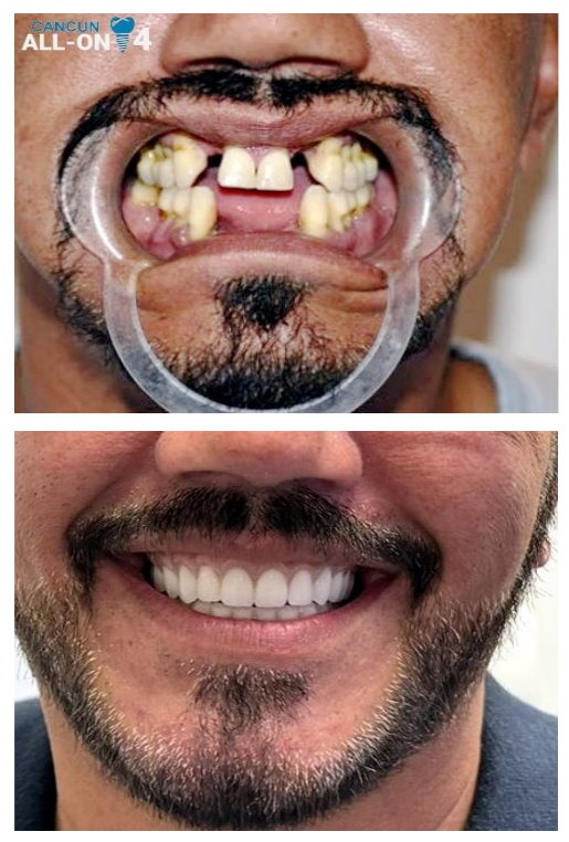 All on 4 full mouth restoration in Cancun