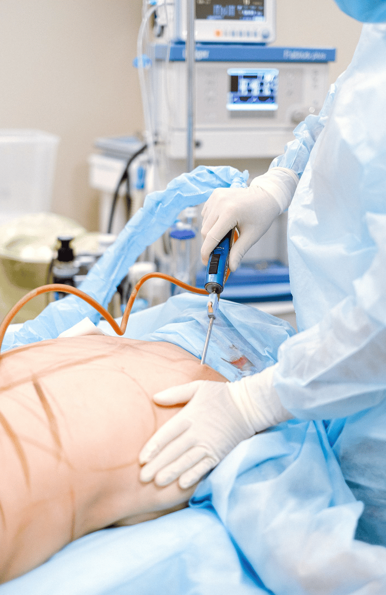 Abdominoplasti ile karın bölgesinin şekillendirilmesi ve sıkılaştırılması