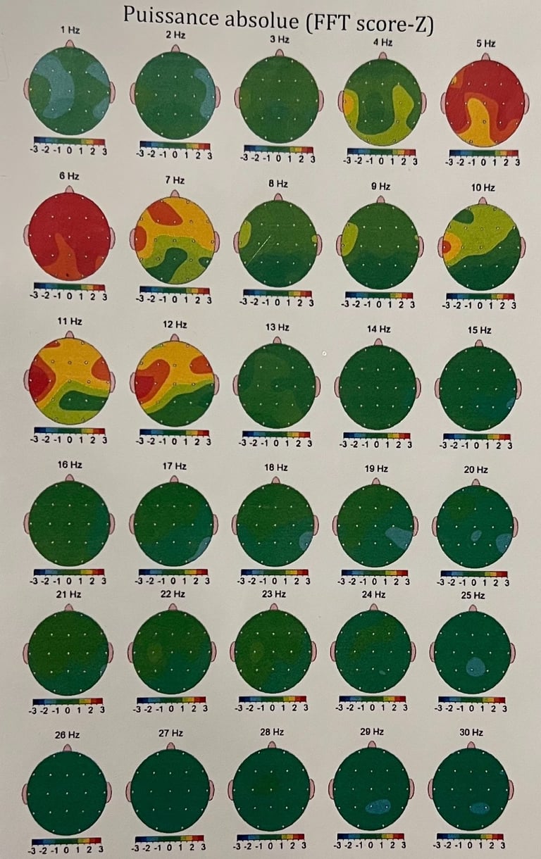 exemple image cartographie EEG Q