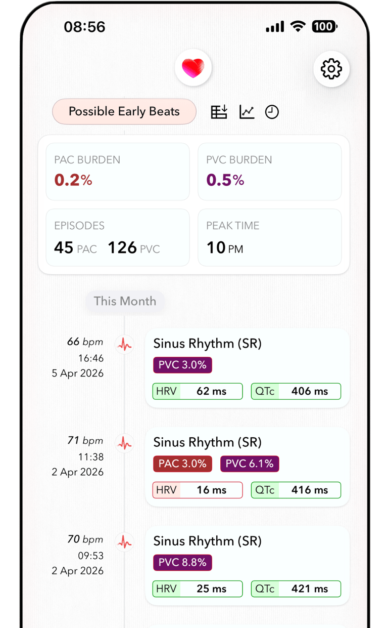 ECG+ app screenshot showing PAC burden (0.2%) calculated for Apple Watch ECG recordings