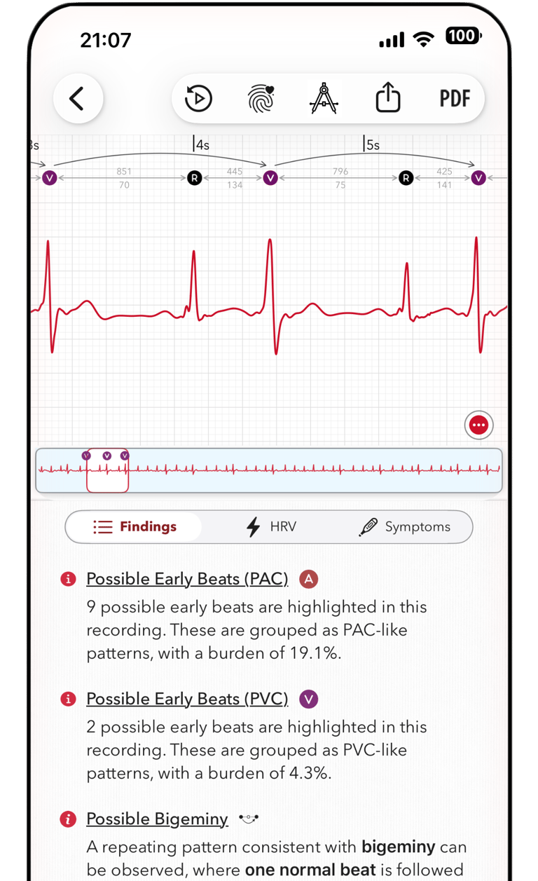 ECG+ app screenshot showing a PVC bigeminy pattern is marked on an Apple Watch ECG report