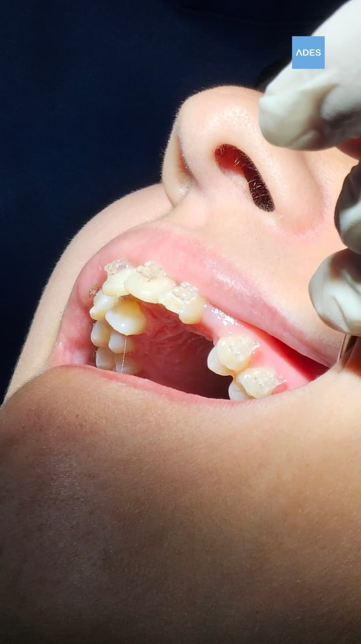 brackets infantil