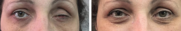 évisceration enucléation prothèse oculaire oculariste nice france avfrance awada