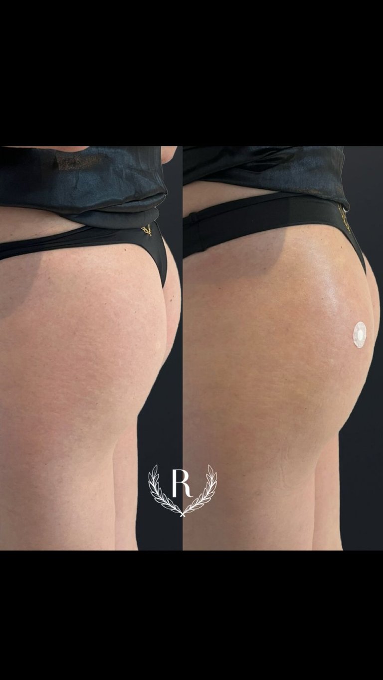 harmonização de glúteos procedimento estético - Tatuapé São Paulo