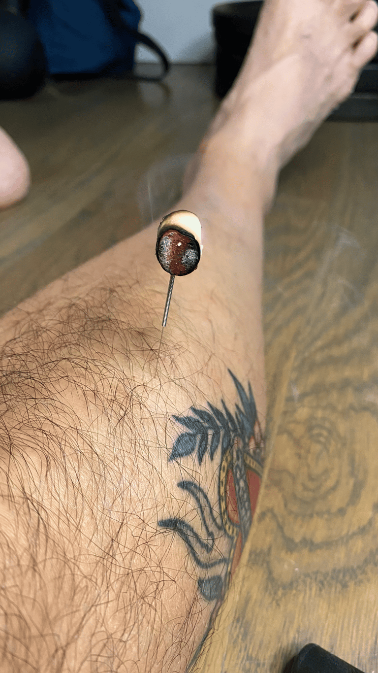 "kyutoshin" or needle moxa burning on top of the needle in Stomach 36. Red embers, white ash & smoke