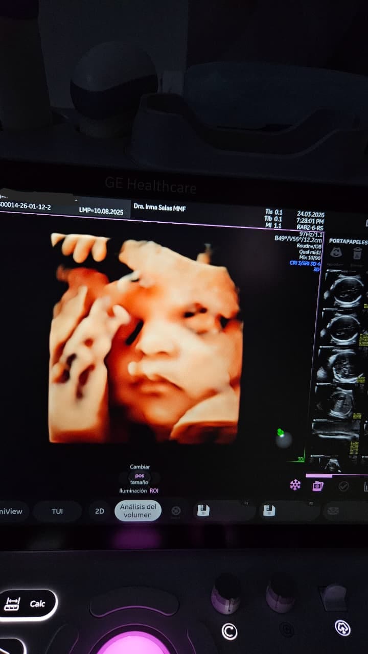 Ultrasonido estructural, ultrasonido segundo trimestre, ultrasonido 3D