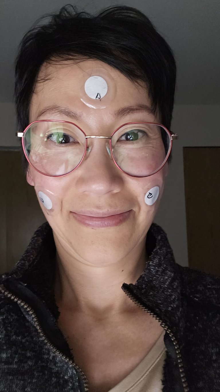 Denise with 3 patches on face